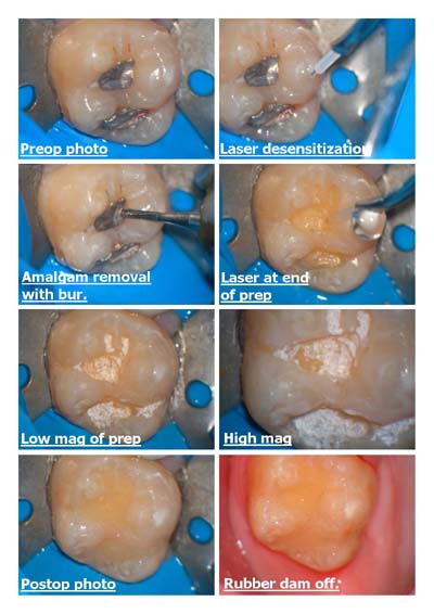 Amalgam removal and laser sterilization.jpg